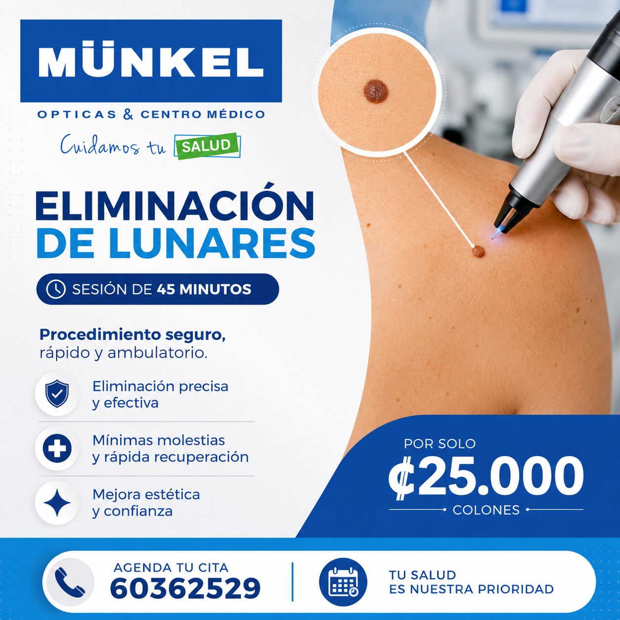 Eliminación de lunares en Centro Médico Munkel por ₡25.000 en sesión de 45 minutos.